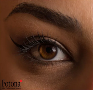 fotona vectorlift